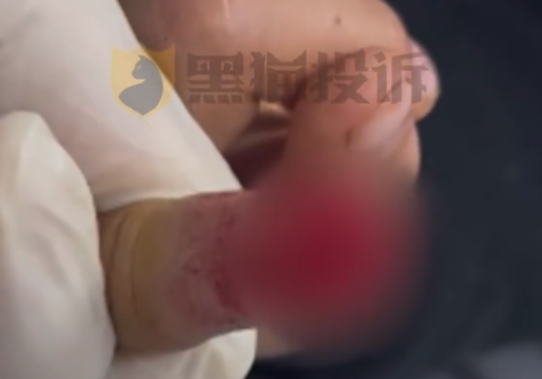 小鹏X9屏幕夹断5岁男童半节食指 家长索赔10万