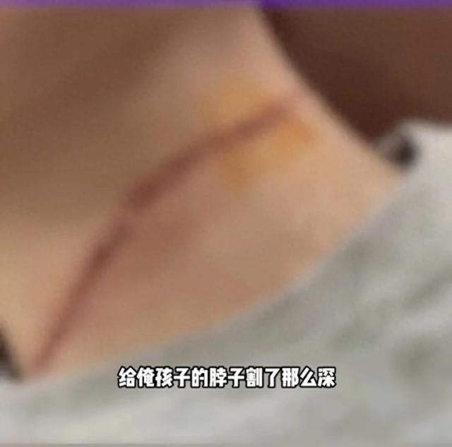 男孩骑车突遭“割喉”，缝了21针！近期高发→