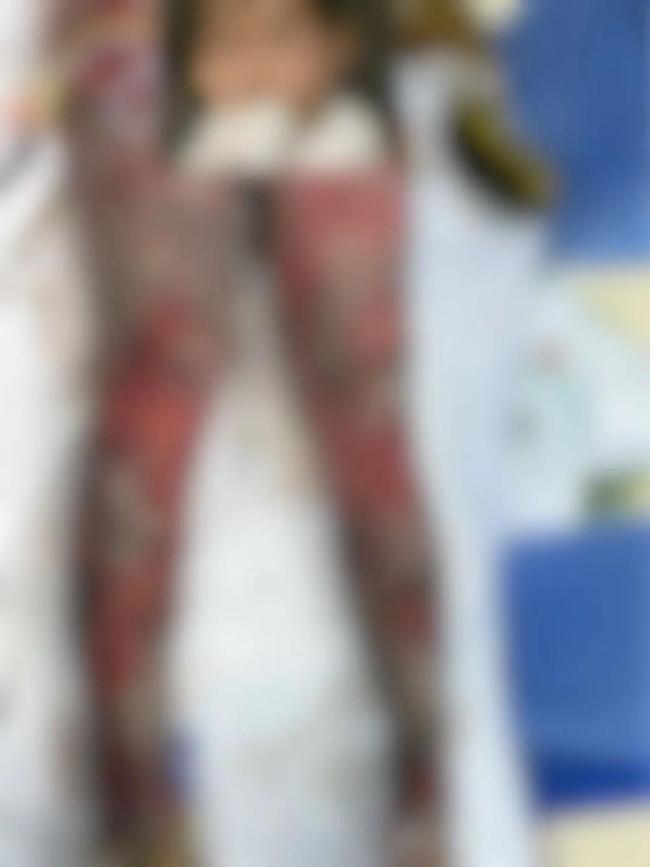 24岁女生租房备考重度烧伤 学业梦想遭重创