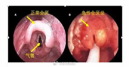 女生喉咙痛从就诊到去世仅10分钟