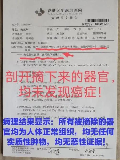 7旬老人没有肿瘤被切除5个器官 术后三个多月老人离世