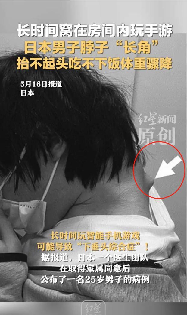 日本男子沉迷手游脖子长角 抬不起头