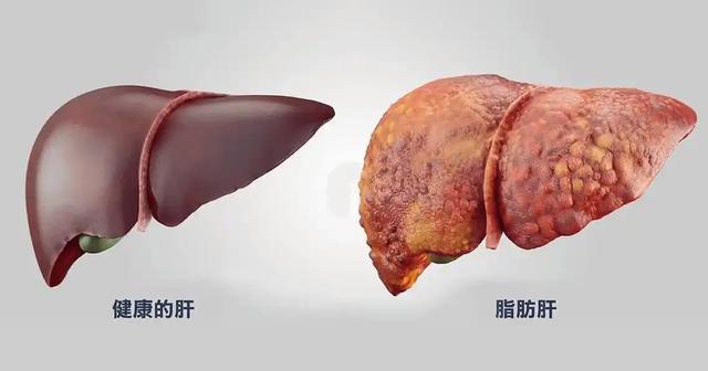 山东一48岁男子查出脂肪肝，戒掉饮酒，半年后去复查，身体如何？ 生活方式需全面调整