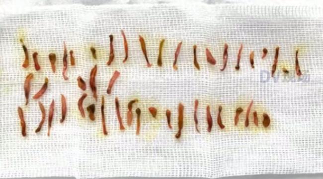 男子吃鱼生致胆管被肝吸虫堵住