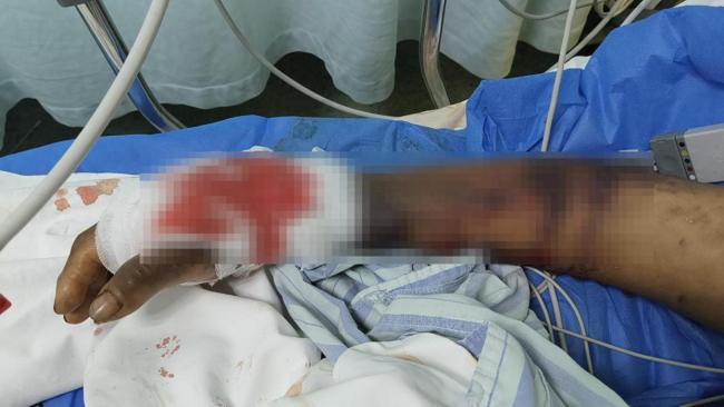 老人被毒蛇咬连打4支血清抢救脱险
