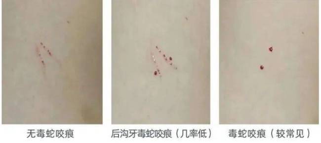 男子被竹叶青咬伤后押送毒蛇看急诊 夏季蛇伤频发