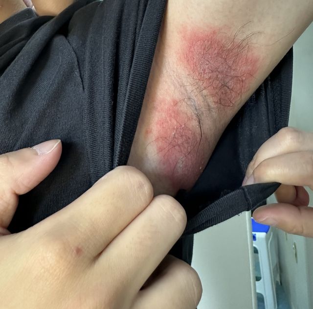 情侣山岗“追星”，回来后男子无法入睡，又疼又痒！